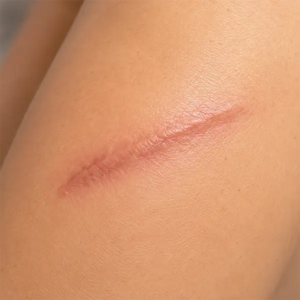Laser Therapy (Photobiomodulation)